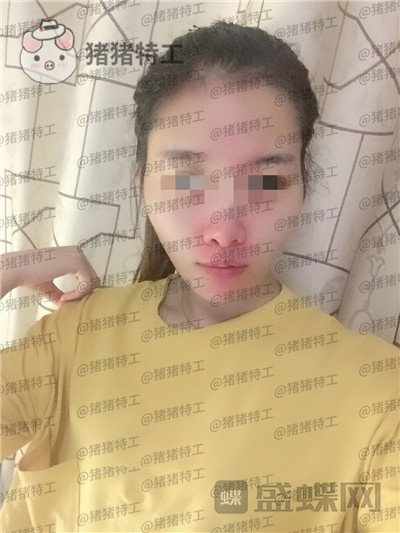 天津南开区奥薇和谐,丛相文,面部填充,案例,价格,