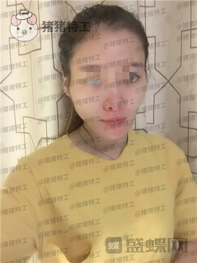 天津南开区奥薇和谐,丛相文,面部填充,案例,价格,