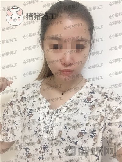 天津南开区奥薇和谐,丛相文,面部填充,案例,价格,