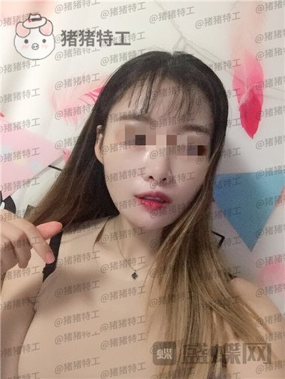 天津南开区奥薇和谐,丛相文,面部填充,案例,价格,
