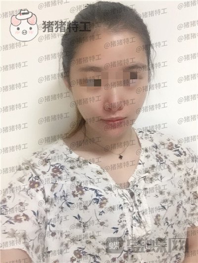 天津南开区奥薇和谐,丛相文,面部填充,案例,价格,