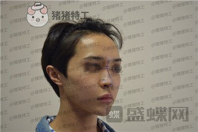 成都西区医院,车红昌,,案例,价格,