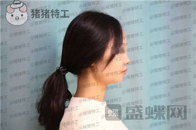 沈阳杏林,朱石江,下颌角磨骨,案例,价格,