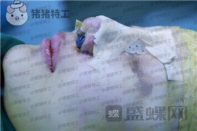 福州,爱美尔,黄振银,隆鼻,案例,价格,