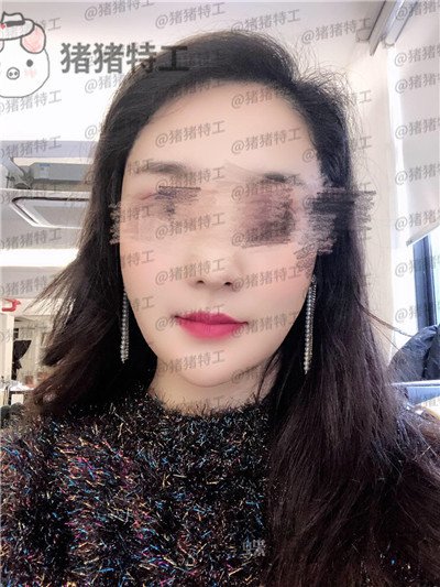 上海愉悦美联臣,曹栋弼,下颌角整形,案例,价格,