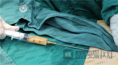 上海愉悦美联臣,荣峥,吸脂,案例,价格,