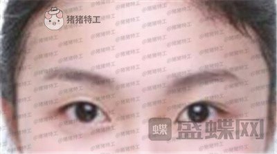 厦门华美,于璇,双眼皮,案例,价格,