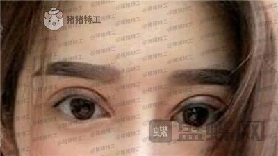 厦门华美,于璇,双眼皮,案例,价格,