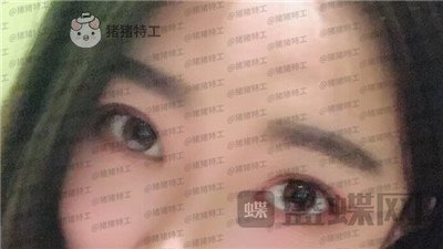 厦门华美,于璇,双眼皮,案例,价格,