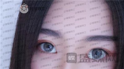 厦门华美,于璇,双眼皮,案例,价格,