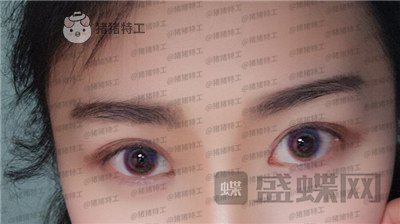厦门华美,于璇,双眼皮,案例,价格,