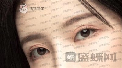 杭州伊琳,毛琪,双眼皮,修复,案例,价格,