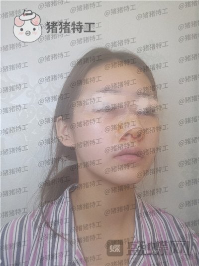 南京美贝尔,黄名斗,面部填充,案例,价格,