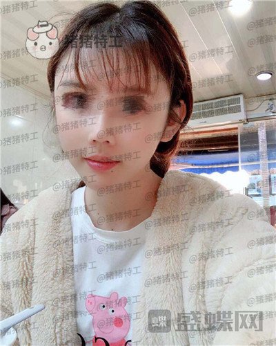 福州星龄,黎护忠,面部填充,案例,价格,