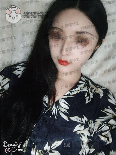 成都格莱丽,王伟,面部填充,案例,价格,