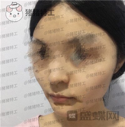 成都格莱丽,王伟,面部填充,案例,价格,