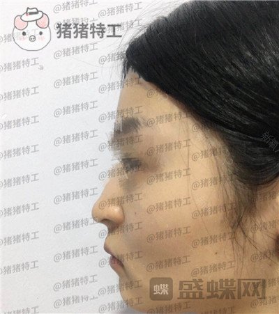 成都格莱丽,王伟,面部填充,案例,价格,