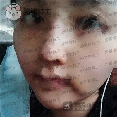 成都格莱丽,王伟,面部填充,案例,价格,