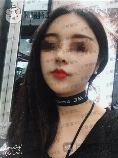 成都格莱丽,王伟,面部填充,案例,价格,