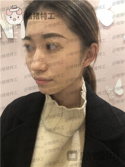 青岛诺德,姜留刚,面部填充,案例,价格,