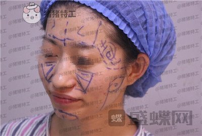 青岛诺德,姜留刚,面部填充,案例,价格,