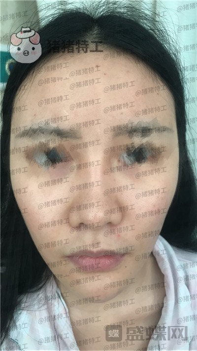 成都军大,文科,,隆鼻,案例,价格,