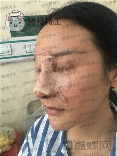 成都军大,文科,,隆鼻,案例,价格,