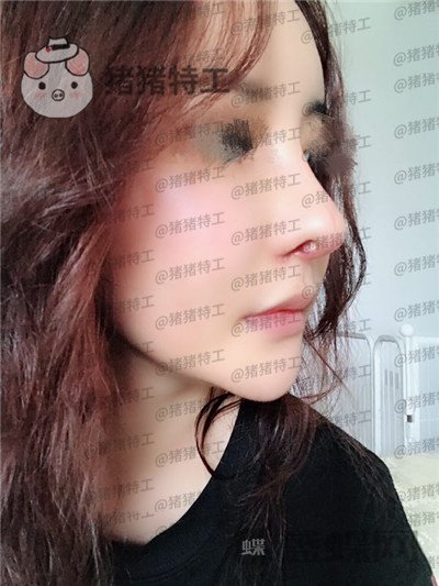 成都军大,文科,,隆鼻,案例,价格,