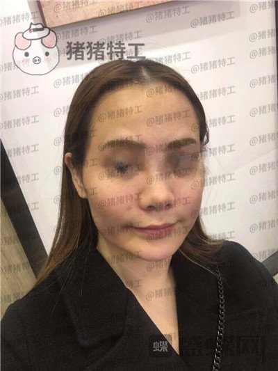 西安医学院,陈杰,面部填充,案例,价格,