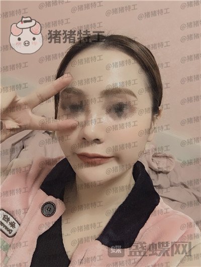 西安医学院,陈杰,面部填充,案例,价格,