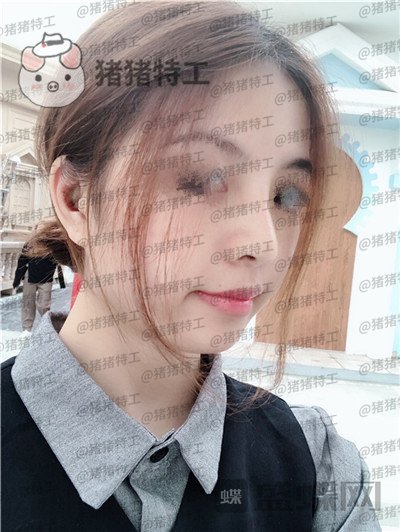 广州曙光,蒋思军,,隆鼻,案例,价格,