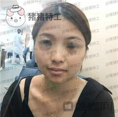 广州曙光,蒋思军,,隆鼻,案例,价格,