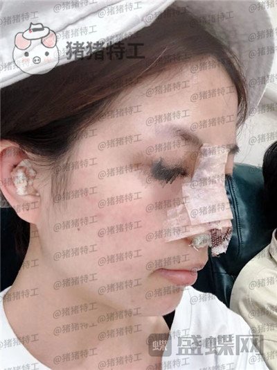 广州曙光,蒋思军,,隆鼻,案例,价格,