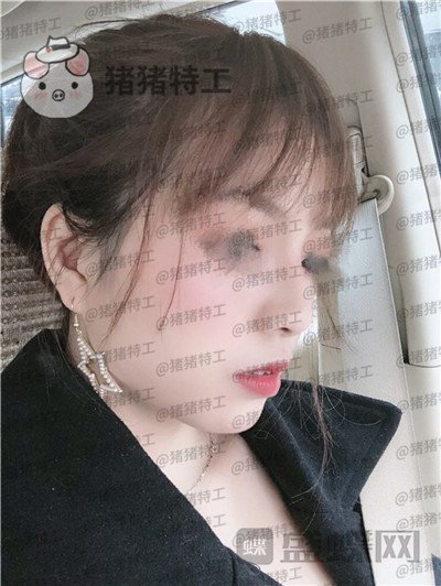 广州曙光,蒋思军,,隆鼻,案例,价格,