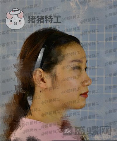 南宁美丽焦点,焦俊光,,隆鼻,案例,价格,