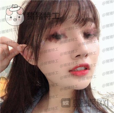 南宁美丽焦点,焦俊光,,隆鼻,案例,价格,