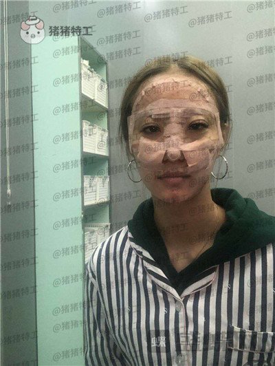 北京润美玉之光,王明利,面部填充,案例,价格,