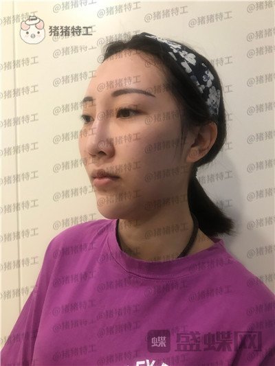 北京玲珑梵宫,张殿祥,面部填充,案例,价格,