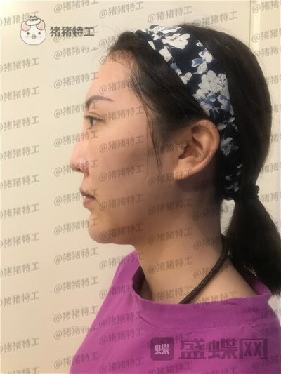 北京玲珑梵宫,张殿祥,面部填充,案例,价格,