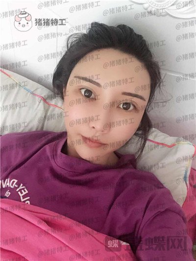 北京玲珑梵宫,张殿祥,面部填充,案例,价格,