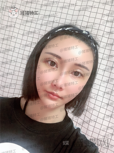 北京玲珑梵宫,张殿祥,面部填充,案例,价格,