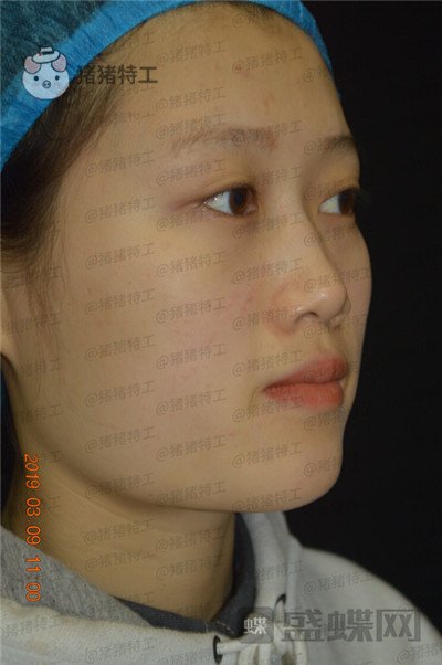 长沙晶肤,朱苗,,案例,价格,