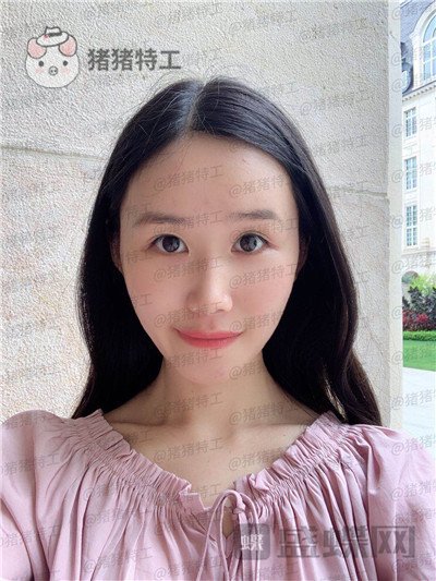 陕西韩媚,王仁根,面部填充,案例,价格,