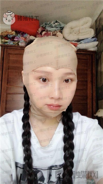 四川友谊,张立天,颧骨整形,案例,价格,