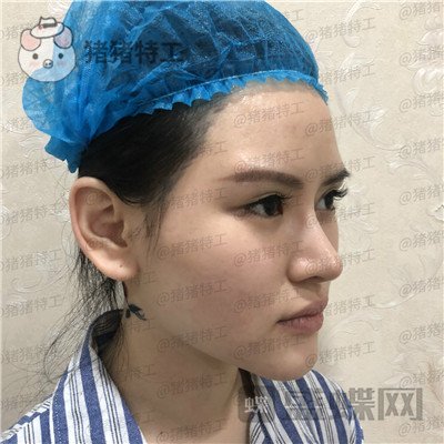 深圳美芮,王权,面部填充,案例,价格,