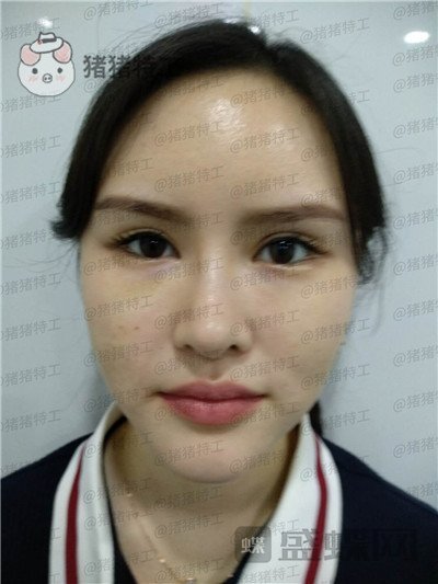 深圳美芮,王权,面部填充,案例,价格,