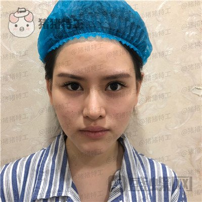 深圳美芮,王权,面部填充,案例,价格,