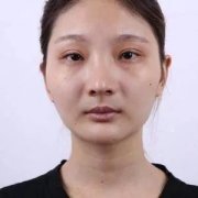 上海华美李志海下颌角＋颧骨内推＋怎么样？案例分享