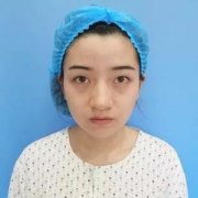 南京美贝尔黄名斗眼怎么样？案例分享