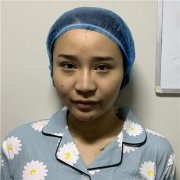 天津菲丝澜党涛肋软骨隆鼻怎么样？案例分享